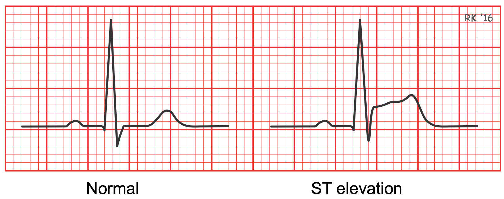 ST segment elevation